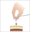 Baxter_20%_needle_insertion_02_04_11